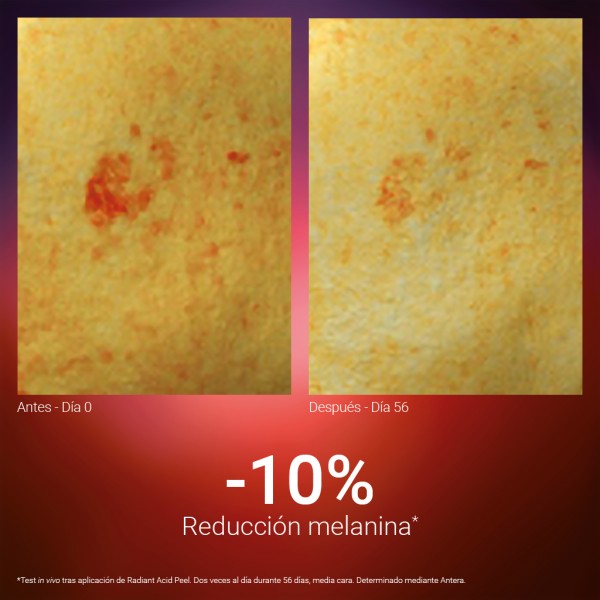 SINGULADERM Radiant Acid Peel 2