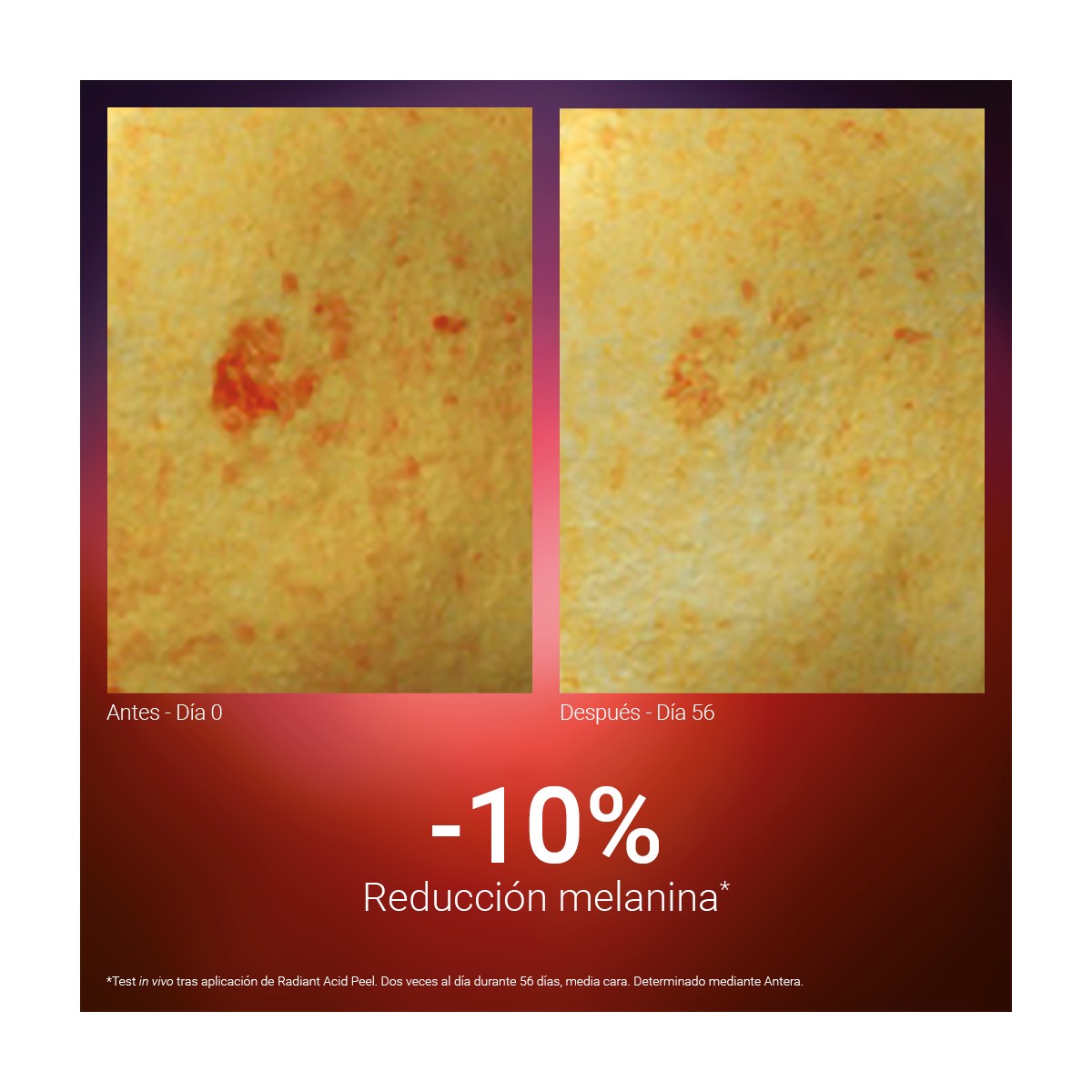 SINGULADERM Radiant Acid Peel